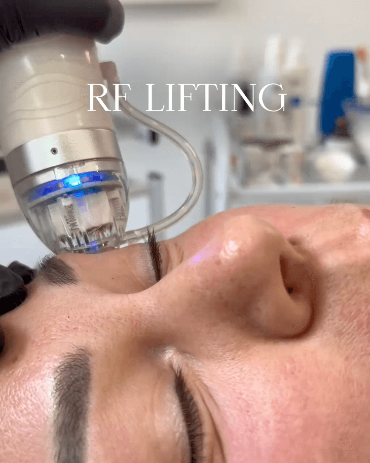 Zabieg RF-liftingu twarzy w Wiśnia Beauty Studio w Warszawie